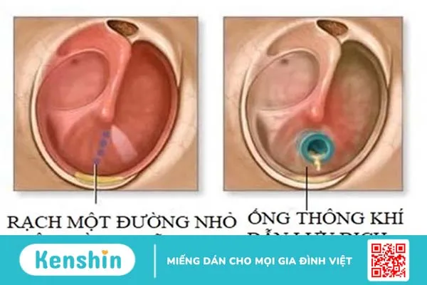 Chi phí phẫu thuật viêm tai giữa bao nhiêu tiền?