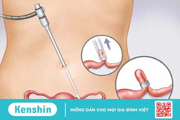 Chi phí triệt sản nữ và các phương pháp được áp dụng hiện nay 3