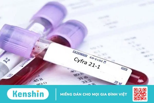 Xét nghiệm CYFRA 21-1 cobas được đề xuất như một công cụ hỗ trợ quan trọng trong quá trình chẩn đoán và giám sát điều trị ung thư phổi