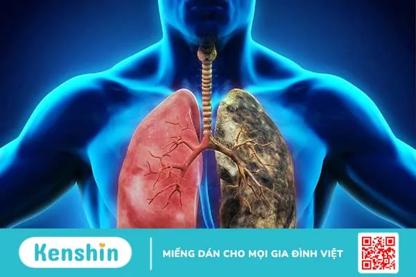 Những người nghi ngờ mắc ung thư phổi được khuyến cáo làm xét nghiệm CYFRA 21-1