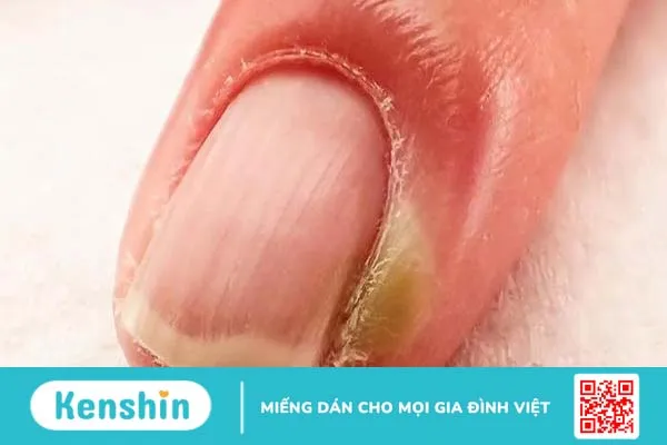 Chín mé ngón tay: Triệu chứng và cách phòng ngừa 1