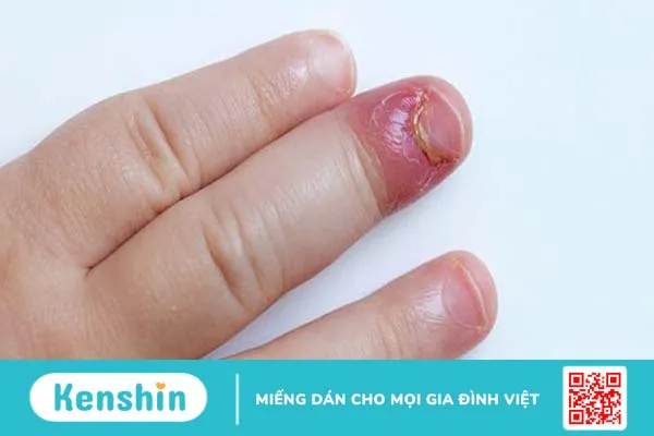 Chín mé ngón tay: Triệu chứng và cách phòng ngừa 4