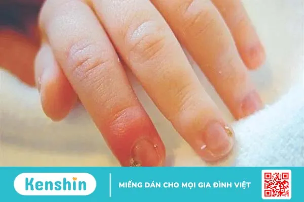 Chín mé ngón tay: Triệu chứng và cách phòng ngừa 2