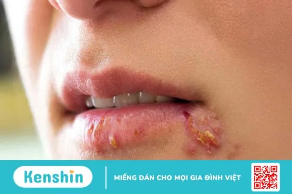 Chốc lở mép miệng là gì?