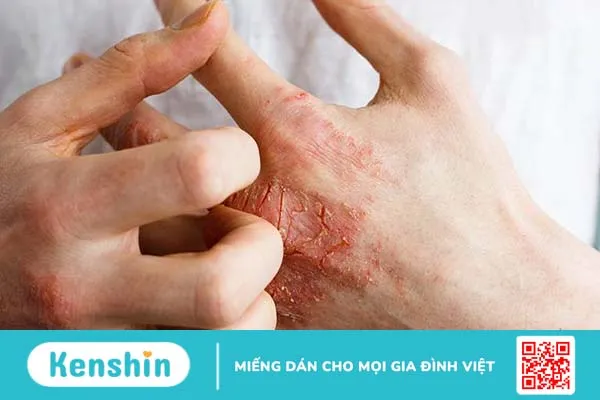 Da nhạy cảm cần dưỡng ẩm sau khi sát khuẩn