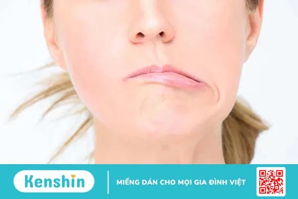 Chữa bệnh liệt mặt lâu năm có hy vọng không?