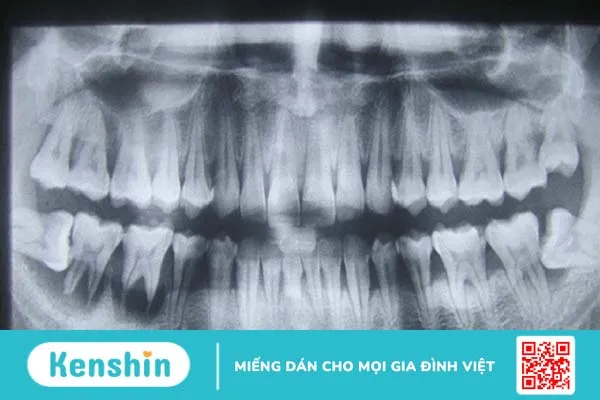 Đánh giá trạng thái răng khôn qua hình ảnh chụp CT trước khi nhổ răng khôn