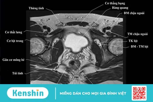 Chụp MRI tiểu khung là gì? Vai trò của chụp MRI tiểu khung ra sao? 1