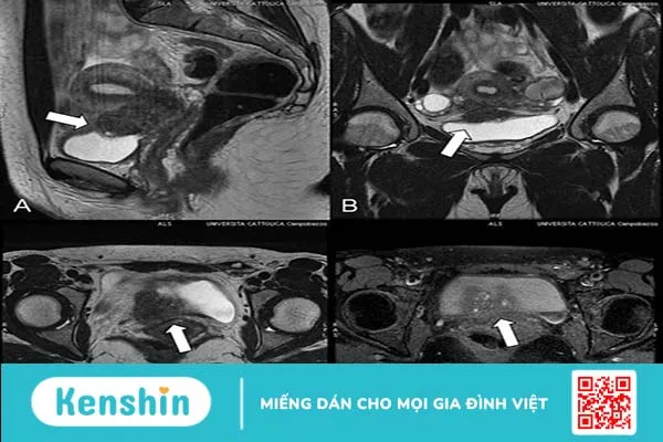 Chụp MRI tiểu khung là gì? Vai trò của chụp MRI tiểu khung ra sao? 2