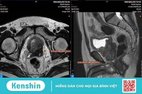 Chụp MRI tiểu khung là gì? Vai trò của chụp MRI tiểu khung ra sao? 3