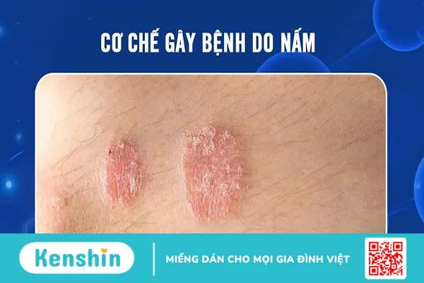 Cơ chế gây bệnh do nấm