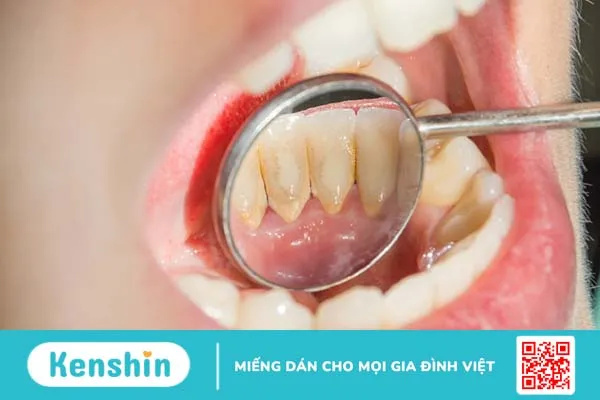 Có nên để vôi răng tự tróc không? Khi nào nên lấy vôi răng 1