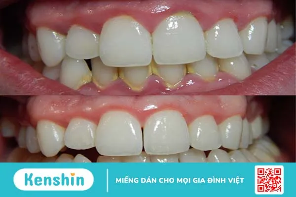 Có nên để vôi răng tự tróc không? Khi nào nên lấy vôi răng 2