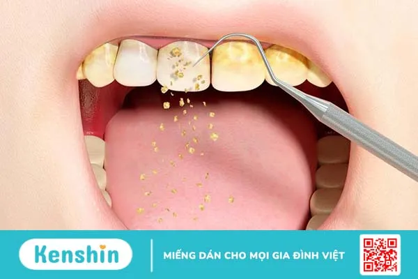 Có nên để vôi răng tự tróc không? Khi nào nên lấy vôi răng 3