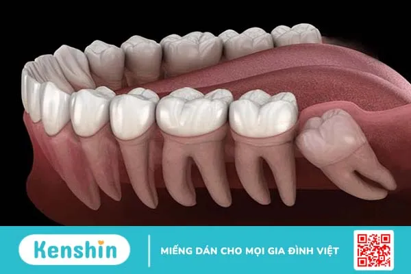 Cung răng là gì? Nhận biết cung răng đẹp như thế nào? 2