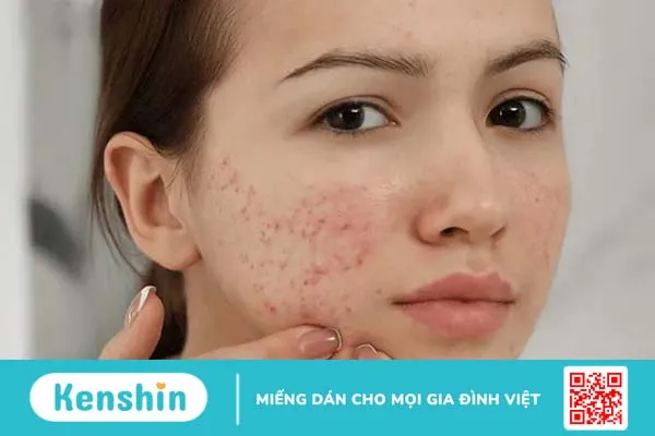 Da bị vết thâm mụn mãi không hết phải làm sao?1