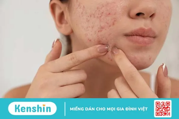 Da bị vết thâm mụn mãi không hết phải làm sao?2