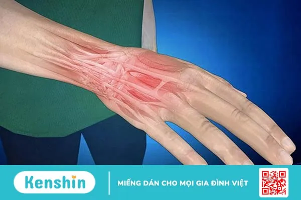 Đánh cầu lông bị đau tay: Nguyên nhân, cách phòng tránh 2