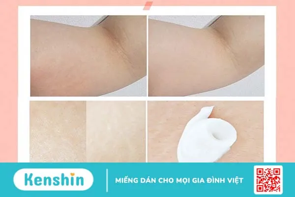 cách chữa rạn da sau sinh lâu năm 5