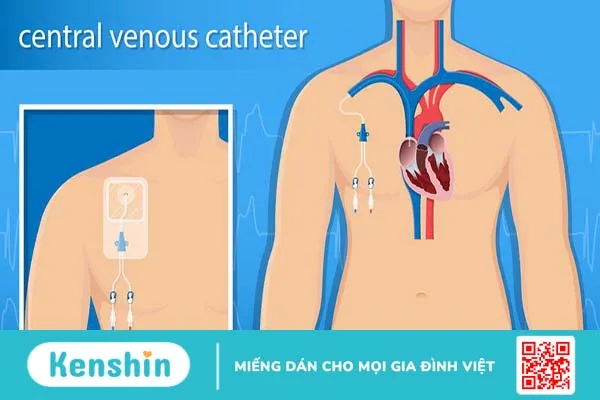 Đặt CVC là gì là câu hỏi nhiều nhiều người thắc mắc