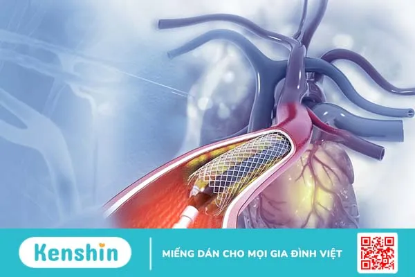 Đặt stent mạch vành và những điều cần biết 3