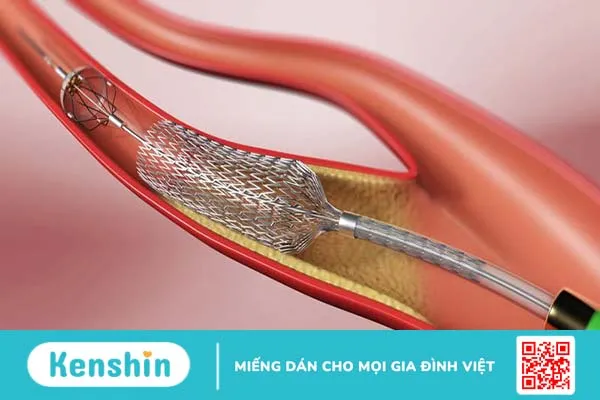 Đặt stent niệu quản là gì? Giải thích chi tiết 1