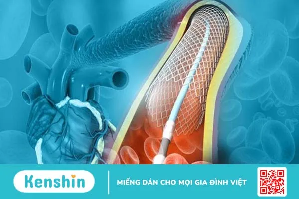 Đặt stent niệu quản là gì? Giải thích chi tiết 2