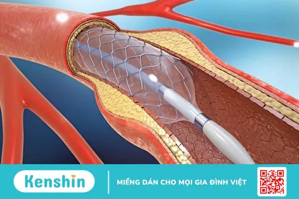 Đặt stent niệu quản là gì? Giải thích chi tiết 3