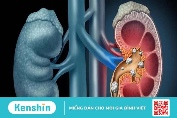 Đặt stent niệu quản là gì? Giải thích chi tiết 4