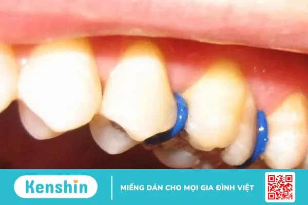 Đặt thun tách kẽ răng để làm gì? Có đau không? Mất bao lâu? 1