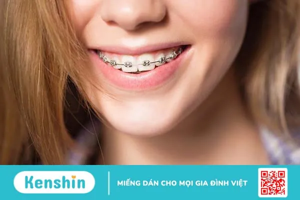 Đặt thun tách kẽ răng để làm gì? Có đau không? Mất bao lâu? 3