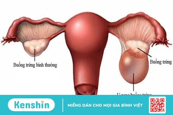 Đau bụng bên trái: Những nguyên nhân thường gặp và cách xử lý 3