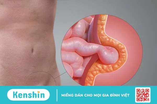 Đau bụng bên trái: Những nguyên nhân thường gặp và cách xử lý 4