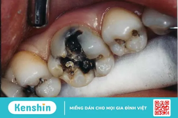 Đau chân răng và những điều cần biết 4