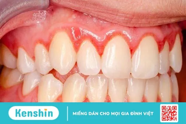 Đau chân răng và những điều cần biết 3