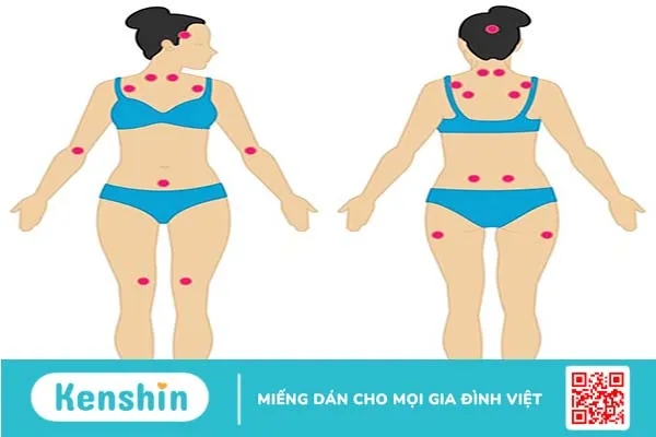 Đau cơ xơ hóa: Triệu chứng, nguyên nhân và cách chữa trị 2