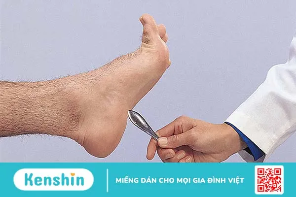 Dấu hiệu Babinski là gì? Cách khám và chẩn đoán dấu hiệu Babinski 3