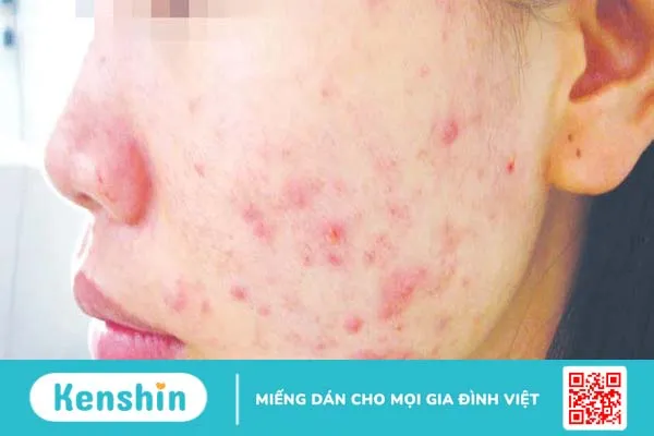 Dấu hiệu dị ứng mỹ phẩm nhẹ và cách xử lý 1