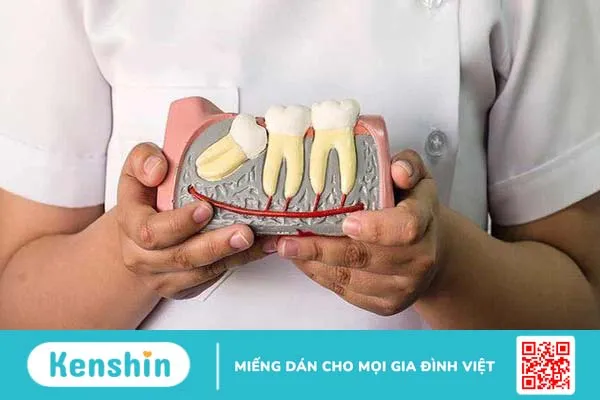 Dấu hiệu mọc răng khôn và trường hợp cần phải nhổ 1