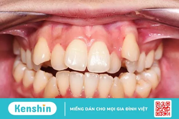 Dấu hiệu mọc răng khôn và trường hợp cần phải nhổ 3