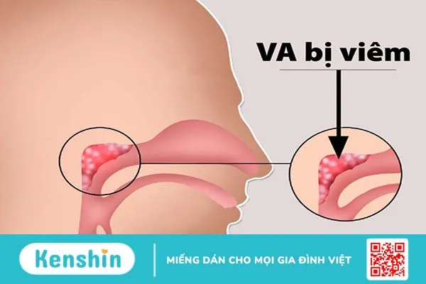 Đau trong tai khi nhai là dấu hiệu của bệnh gì? Đây có phải bệnh nguy hiểm? 2