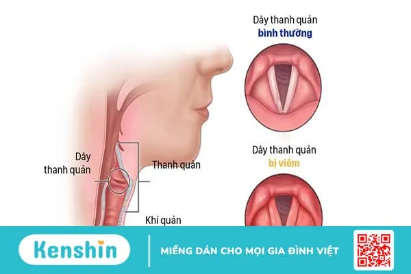 Dây thanh quản là gì? Dây thanh quản nằm ở đâu? 4