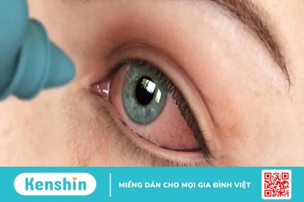 Đeo lens nhiều có hại mắt không?2