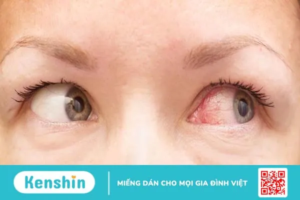 Đeo lens nhiều có hại mắt không?3