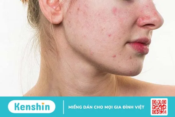 Làn da bị mụn dễ bị nhiễm khuẩn bởi những tác nhân từ môi trường, dẫn đến tình trạng sẹo thâm mụn nặng hơn