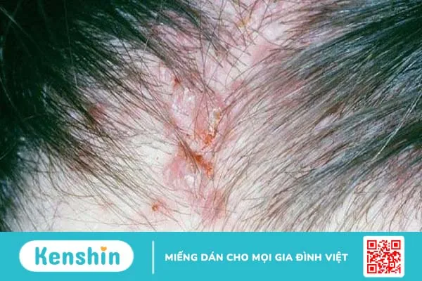 Đi tìm lời giải đáp cho câu hỏi: Ung thư da đầu có nguy hiểm không? 2