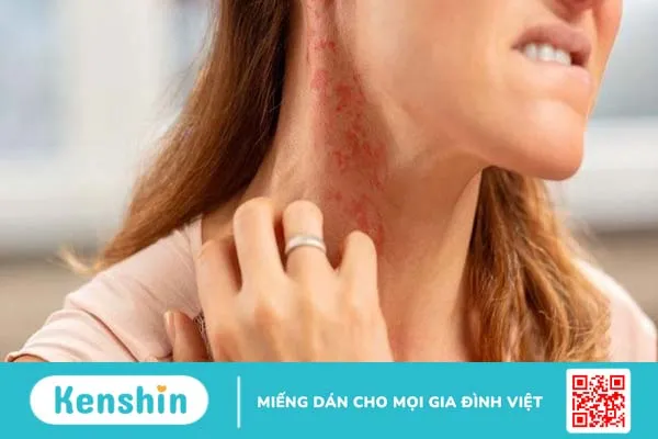 Dị ứng chuối và những điều mà bạn nên biết 2