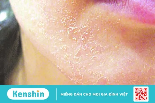 Dị ứng cồn trong mỹ phẩm: Dấu hiệu nhận biết và cách xử lý 2