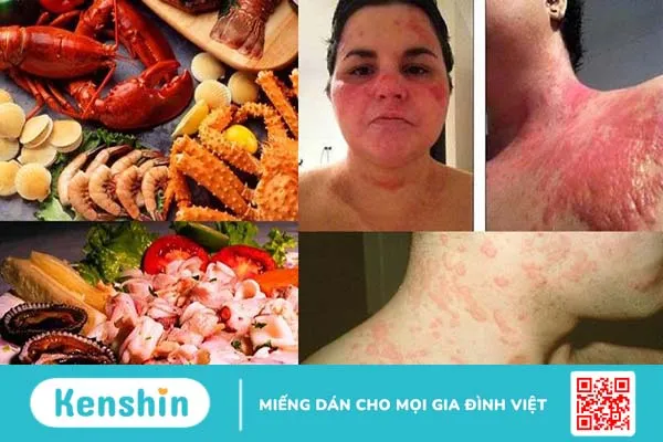 Dị ứng động vật có vỏ: Triệu chứng, nguyên nhân và cách xử trí 2