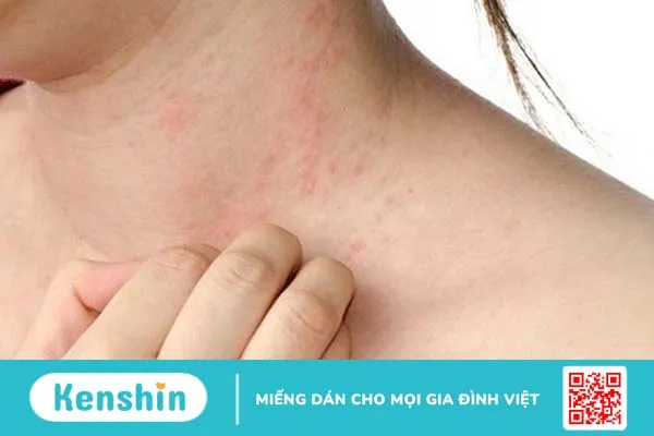 Dị ứng hạt mè và những mối nguy hại cho sức khỏe